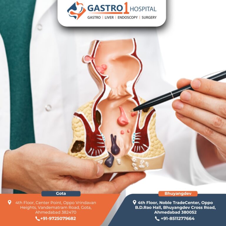 PilesTreatmentAhmedabad Gastro1 Hospital 3 768x768
