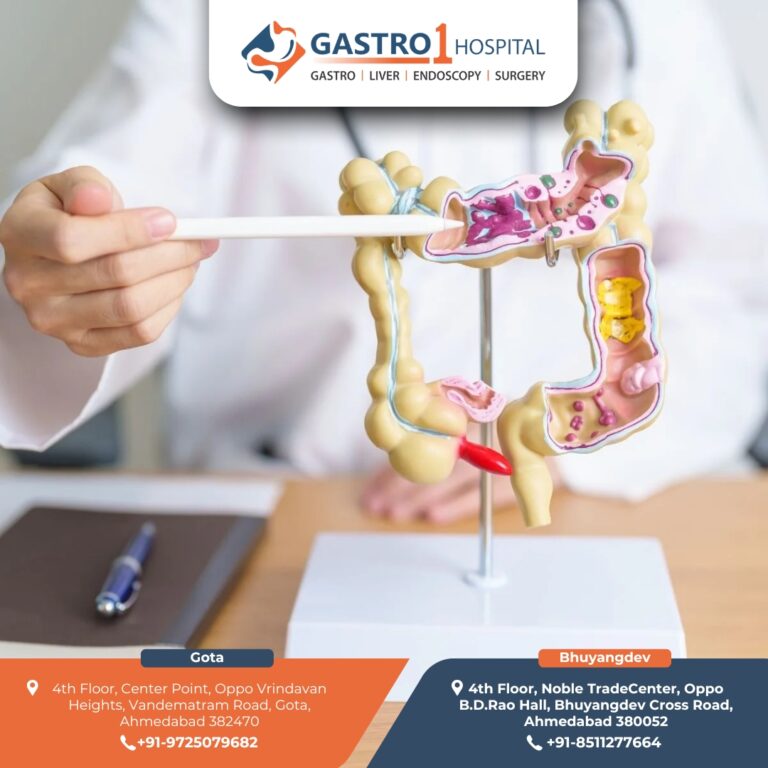 bestIBSTreatmentAhmedabad Gastro1 hospital 1 768x768