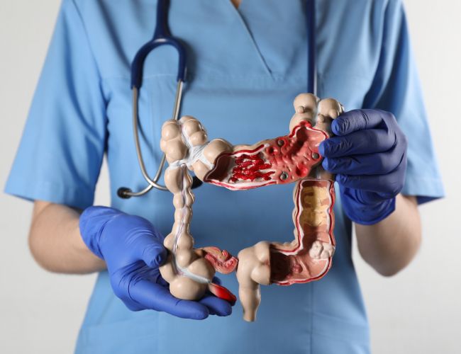 colon cancer surgery