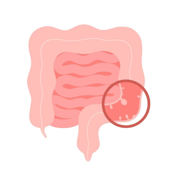 colonoscopy intestine polypectomy procedure removal 600nw 2116295183