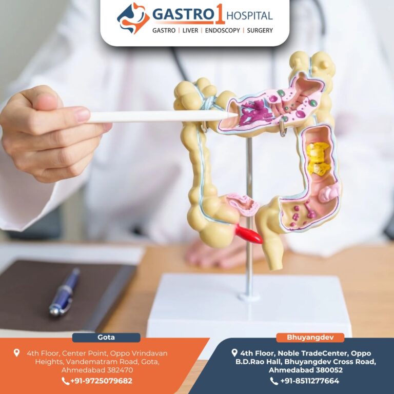 IBSTreatmentAhmedabad Gastro1 Hospital 4 768x768